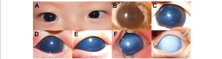 representative photographs of corneal abnormalities