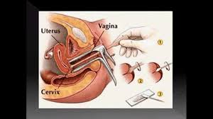 Most doctors recommend that women or people who were assigned female at birth get a pap smear. Pap Smear Adalah Youtube