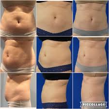 The risks are few and rare. My Coolsculpting Journey