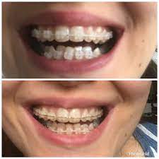 For most people, braces are necessary to correct the problem. Lower Braces 5 Weeks Progress But Worried About Crossbite Still Braces