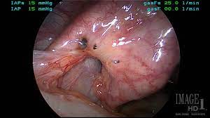 Impact of endometriosis on quality of life and work productivity: Endometriosis And Infertility State Of The Art Management Ivf1