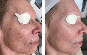 Image result for Solar Lentigo