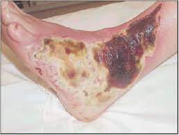 The eschar acts as a natural barrier to infection, keeping the bacteria from entering the wound. Hot Water Bottles And Diabetic Patients A Cautionary Tale British Journal Of General Practice