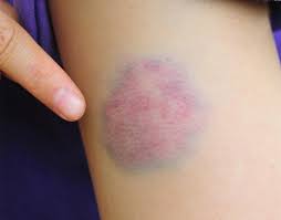 Vucuttaki Morluklar Neden Ve Nasil Olusur Labmedya Tv