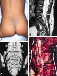 Image result for Spinal Dysraphism