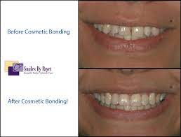 The most common small teeth are the. Cosmetic Tooth Bonding Charlotte Dentist Close Gaps In Teeth
