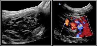If an ultrasound would image a tumor in the throat as well as the neck above the collar bone it would be pointless to have another procedure done. The Radiology Assistant Neck Masses In Children