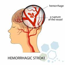 Learn about emergency and stroke treatment is about halting the potential problems that a stroke can cause before the damage. Therapeutic Stem Cells Treatment For Stroke Recovery Rehab