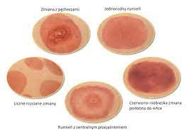 Maybe you would like to learn more about one of these? Borelioza Co Farmaceuta Powinien Wiedziec Aptekarz Pl