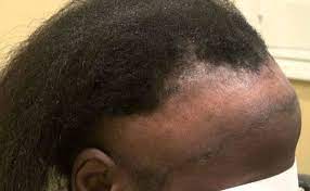 The sudden development of bald spots on the scalp, eyebrow, or beard can indicate a hair loss condition called alopecia areata. 4 Reasons Why Your Bald Spot Is Kind Of A Big Deal Naturallycurly Com