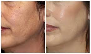 Microdermabrasion Machines By Dermaglow Skincare Cicatriz De Acne Produtos Para A Pele Pele