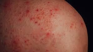 Maybe you would like to learn more about one of these? Coronavirus Long Haulers Are Developing Rashes A Sign Of Inflammation