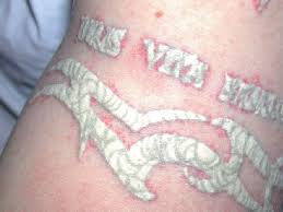 Disappearing ink is proud to offer the most advanced laser tattoo removal treatments in the pittsburgh area. Tattoo Removal Disasters