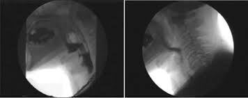 Image result for Tensilon Test