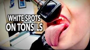 It occurs due to various causes. White Spots On Tonsils Dr Paul Youtube