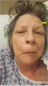 We did not find results for: Frontiers Myasthenia Gravis Masquerading As An Idiopathic Unilateral Facial Paralysis Bell S Palsy A Very Rare And Unique Clinical Find Neurology
