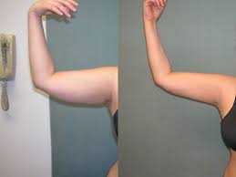 Pin On Arm Lift