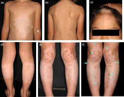 We did not find results for: Repigmentation Of Leukoderma In A Piebald Patient Associated With A Novel C Kit Gene Mutation G592e Of The Tyrosine Kinase Domain Journal Of Dermatological Science