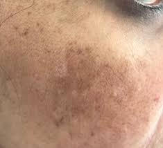 SKIN PIGMENTATION | Chandigarh Ayurved & Panchakarma Centre