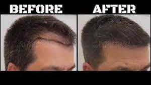 Sac Ekimi 2500 Graft F U E N I T By Op Dr Zekeriya Kul