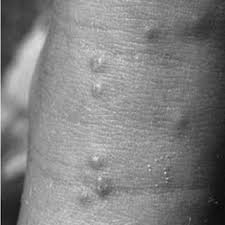 Hydrocortisone or triamcinalone cream locally and antihistamines such as allegra or claritin. Pdf Eosinophilic Fasciitis Induced By Fire Ant Bites