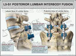 L5 S1 Posterior Lumbar Interbody Fusion Plif Small 8 5 X 11 Digital Presentation Digital File Spinal Fusion Surgery Lumbar Spinal Fusion