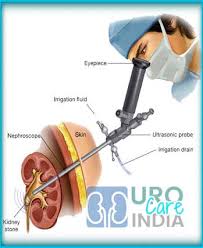 Best Cost Lithotripsy Surgery In India Top Hospital Surgeon Delhi Mumbai Chennai Hyderabad Banglore India