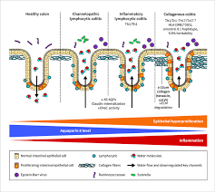 Image result for Microscopic Colitis