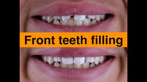 That's because composite fillings require the tooth be kept clean and dry while the cavity or damage is being filled. Front Teeth Filling Youtube