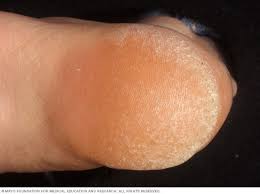 A lump in the throat, mouth or neck; Corns And Calluses Symptoms And Causes Mayo Clinic