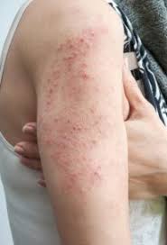 It typically looks like an eczema rash and can affect parts of the body outside of the skin, such as the blood or internal organs in some cases. Risk Factors Of Skin Cancer Inurskn