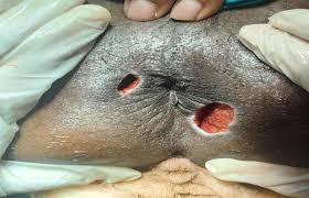 Image result for Ischiorectal Abscess