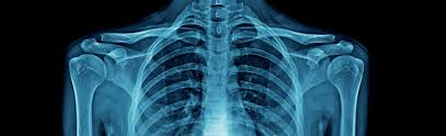Image result for lung cancer xray