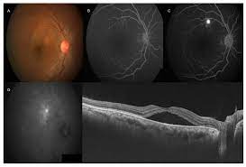 The two opthamologists who initially diagnosed me with csr had. Vision Free Full Text Current Choroidal Imaging Findings In Central Serous Chorioretinopathy Html