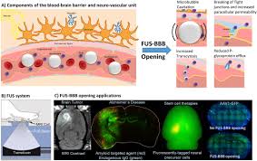 We know 450 definitions for bbb abbreviation or acronym in 8 categories. J Controlled Release On Twitter Secondary Effects On Brain Physiology Caused By Focused Ultrasound Mediated Disruption Of The Blood Brain Barrier Nick Todd Harvard Medical School 50 Days Free Access Https T Co Bqemsfubqg Https T Co