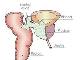 Treatment of metastatic cancer focuses on slowing the spread of the cancer and relieving symptoms, such as bone pain. Metastatic Prostate Cancer Irish Cancer Society