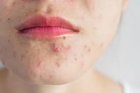 Acne Por Estres Caracteristicas Y Como Eliminarlo
