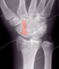Check spelling or type a new query. Avoiding Distal Radius Fracture Complications Broken Wrist