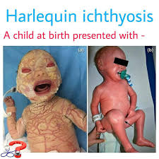 Image result for Ichthyosis