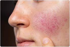 Rosacea Research