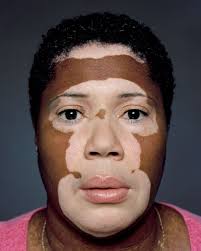 Black And White Skin Condition Model Vitiligo Affects Millions Of Americans This Artist Is Building A Collection Of Beautiful Photographs Of This Diseas Vitiligo Treatment Health Fitness Vitiligo