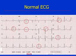 The ecg is an important and easy modality which can assist in the diagnosis and prognostication of acs. Acute Coronary Syndrome Nstemi