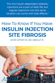 What Is Insulin Injection Site Fibrosis Astym Blog Insulin Injection Sites Physical Therapy Programs Injections