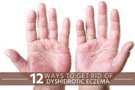 Learn what triggers dyshidrotic eczema and how to treat it. 19 Dyshidrotic Eczema Ideas Eczema Eczema Remedies Eczema Treatment