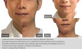 Image result for Botulinum Toxin Injection