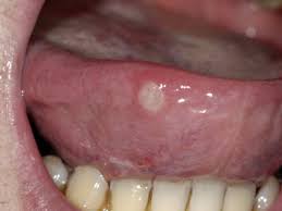 Image result for white cancer on tongue)