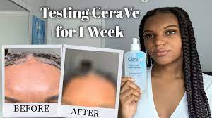 A scar is an area of fibrous tissue that remains after the skin has been wounded and healed. Cerave Renewing Sa Cleanser Review I Tried Cerave For 1 Week Youtube