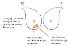 Sleep the whole night with this pack on your breast. Baby Friendly E News May 2018 Are My Breast Lumps Chronic Blocked Ducts