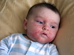 In the meantime, you may want to loosen and remove the scales on your baby's scalp: Signs And Treatment Of Cradle Cap In Babies Ifmch Bridging The Gap