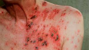 Image result for skin rash acute hiv infection